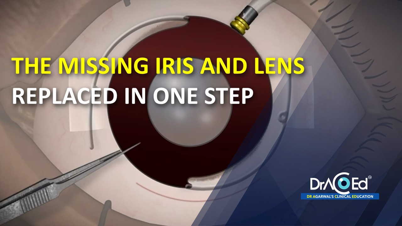 THE MISSING IRIS AND LENS - REPLACED IN ONE STEP